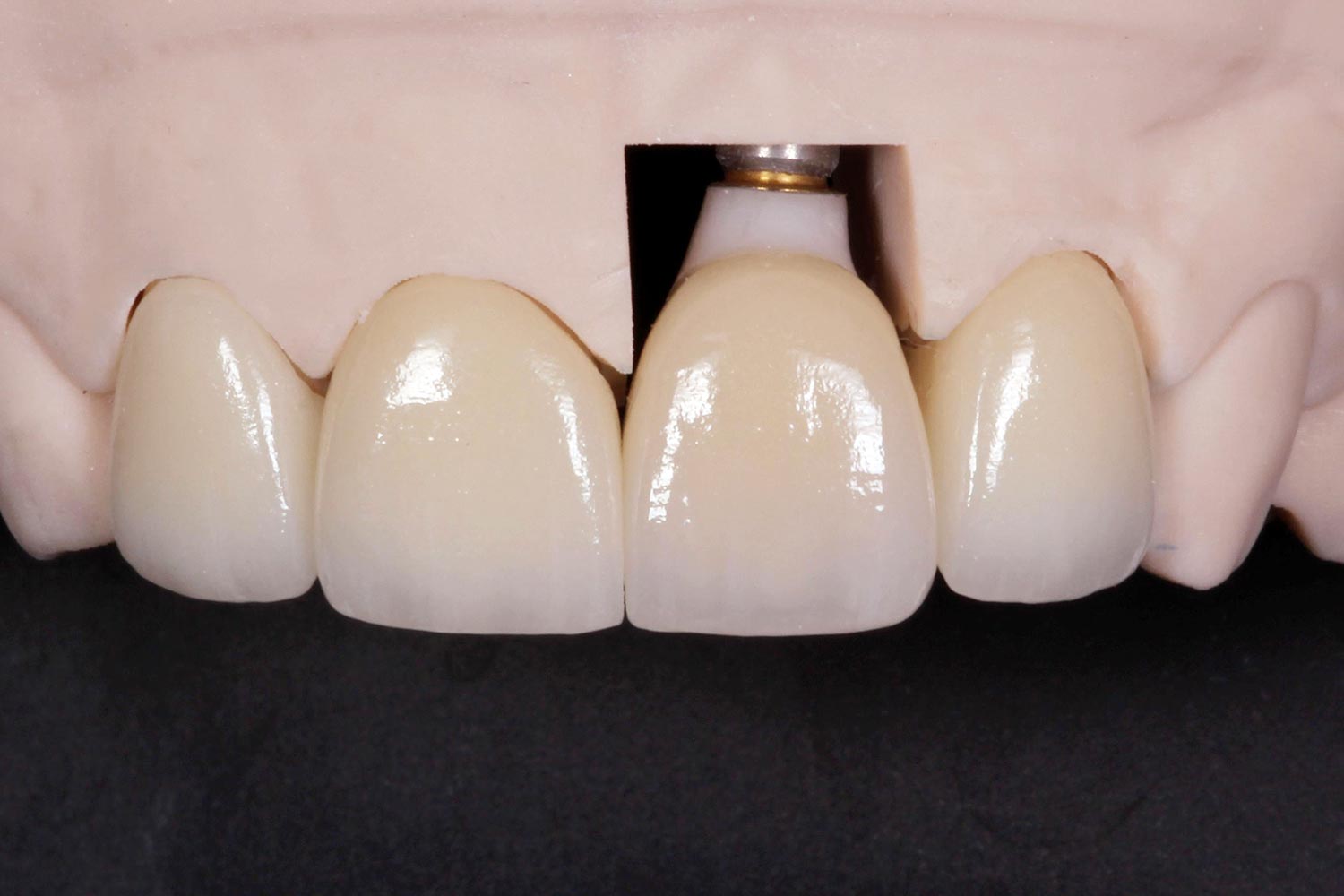 Cabinet Deintaire Archamps - Implant Dentaire