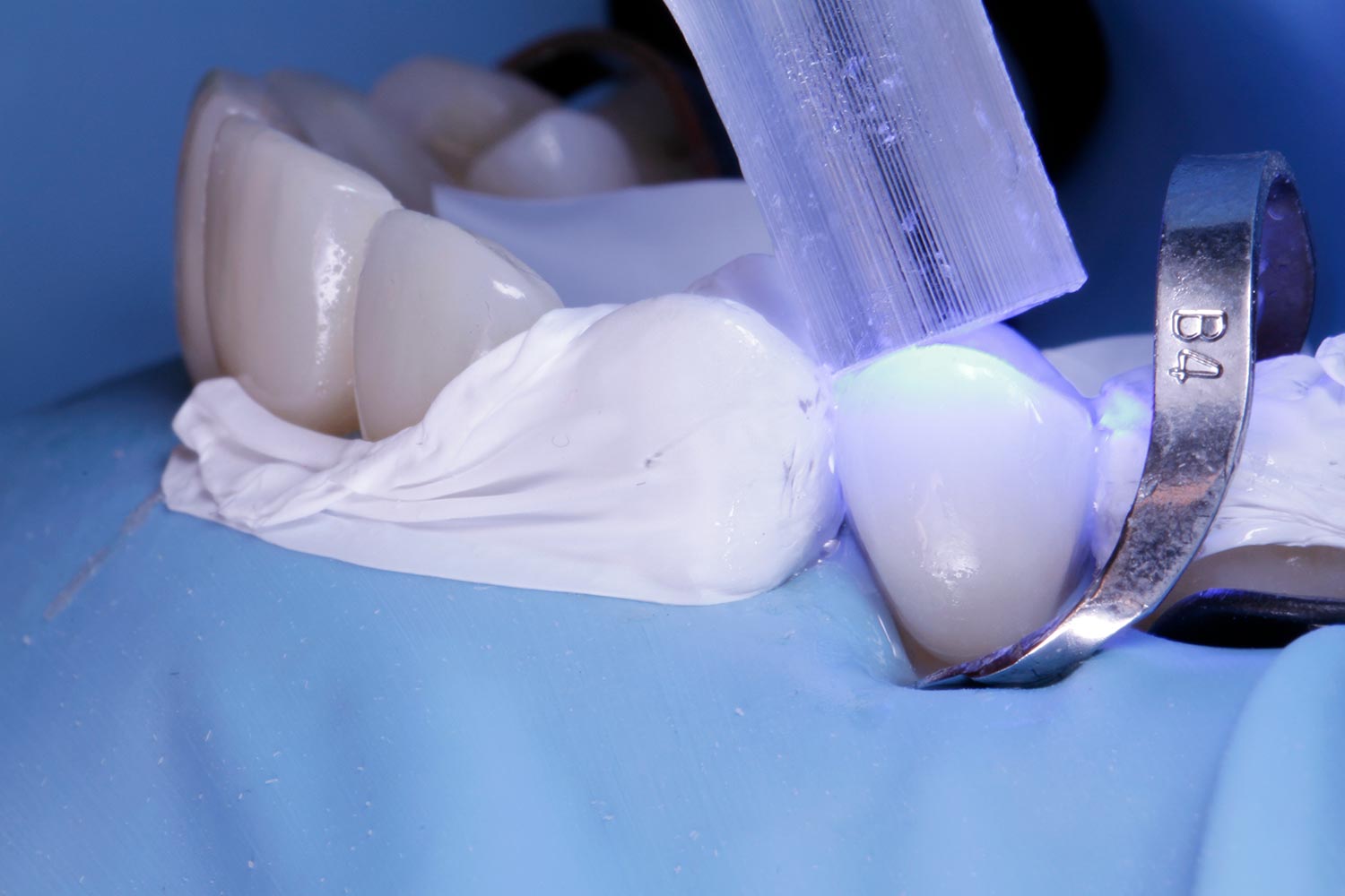 Cabinet Deintaire Archamps - Remplacement des amalgames dentaire